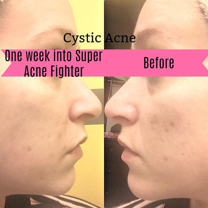 White Smokey Super Acne Fighter organic skincare treatment in a jar, featuring natural ingredients for acne-prone skin care.